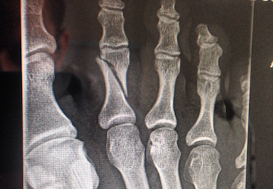 PHOTO | Luke Rockhold’s Broken Toe (X-Ray)