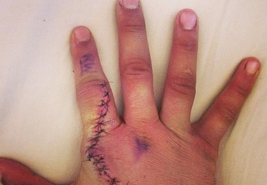 PHOTO | Ian McCall Undergoes Hand Surgery