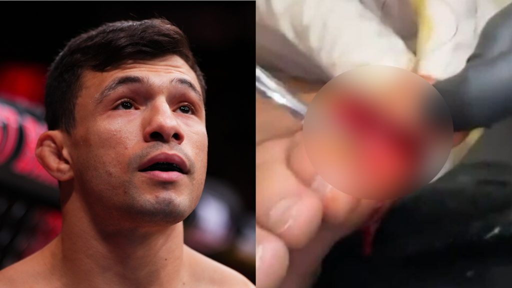 Alessandro Costa enters the Octagon for his fight against Alden Coria at Noche UFC, opposite a graphic, blurred image of Costa's toe injury