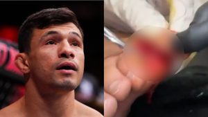 Alessandro Costa enters the Octagon for his fight against Alden Coria at Noche UFC, opposite a graphic, blurred image of Costa's toe injury